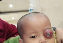 Aysha Maydita Butuh Bantuan Dermawan Untuk Operasi Matanya