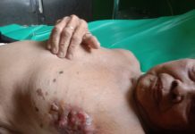 Saini Wanita Penderita Kanker Payudara Perlu Perhatian Pemerintah